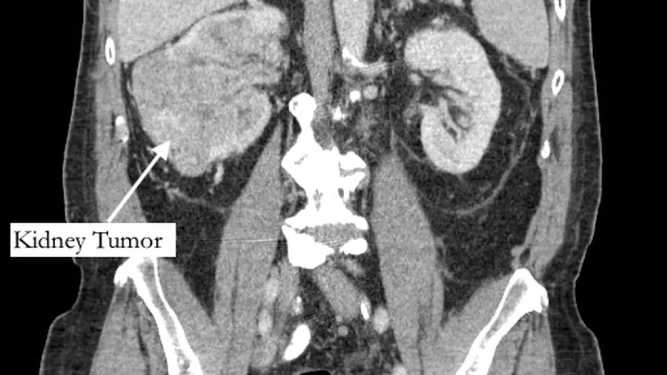 im-0001-0080-bernstein-ct-tumor-image