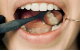 Cuidar da saúde bucal previne doenças neurodegenerativas: entenda relação.Saiba como infecções podem estar relacionadas ao desenvolvimento de doenças neurodegenerativas, como Alzheimer e Parkinson