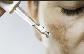 Melasma: saiba qual é a melhor rotina para clarear as manchas,especialistas explicam condição marcada e quais alternativas para reverter o diagnóstico