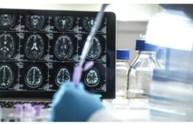 Anvisa aprova 1º tratamento que promete retardar Alzheimer